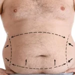 Estética Pós-Bariátrica: Entenda os Desafios e Soluções da Cirurgia Reconstrutora