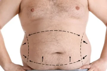 Estética Pós-Bariátrica: Entenda os Desafios e Soluções da Cirurgia Reconstrutora