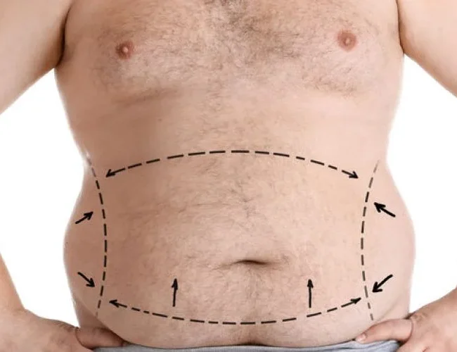 Estética Pós-Bariátrica: Entenda os Desafios e Soluções da Cirurgia Reconstrutora